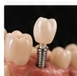 Implantes dentários